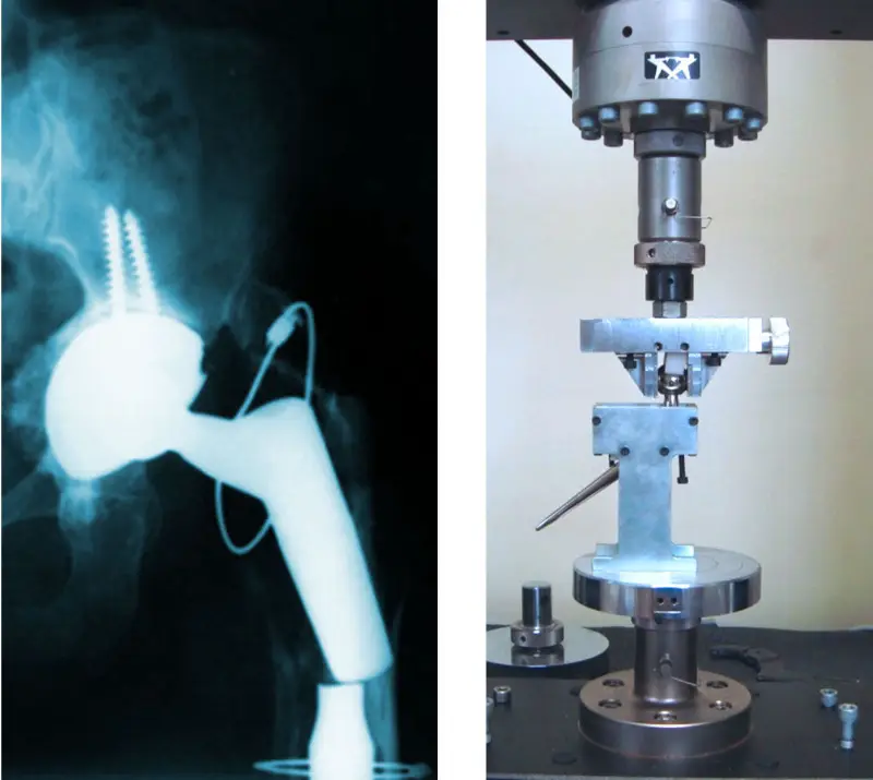 Implant analysis for ANVISA